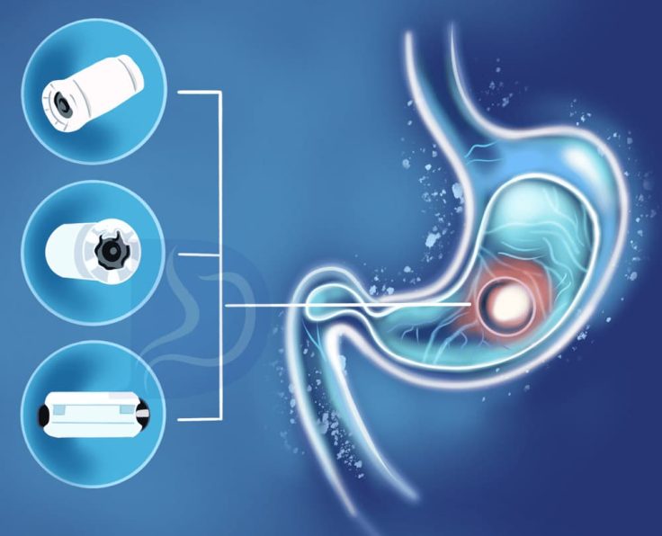 capsule-endoscopy(2) capsule-endoscopy(2)