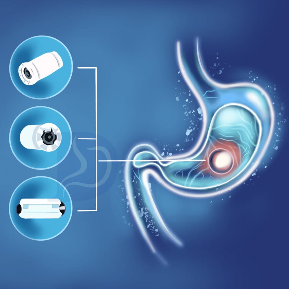 Capsule endoscopy(2)
