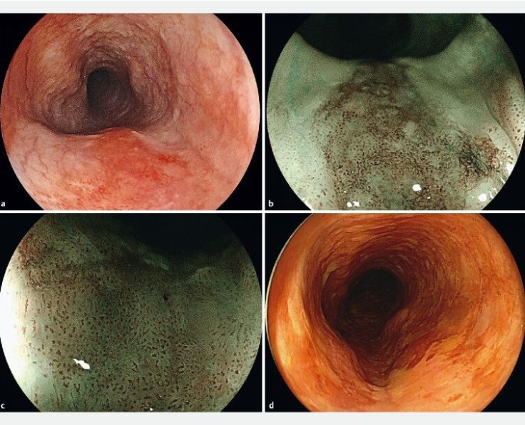 Early-esophageal-squamous-cell-carcinoma-detected-by-BLI-ME-endoscopy-WLI-BLI-brownish Early-esophageal-squamous-cell-carcinoma-detected-by-BLI-ME-endoscopy-WLI-BLI-brownish