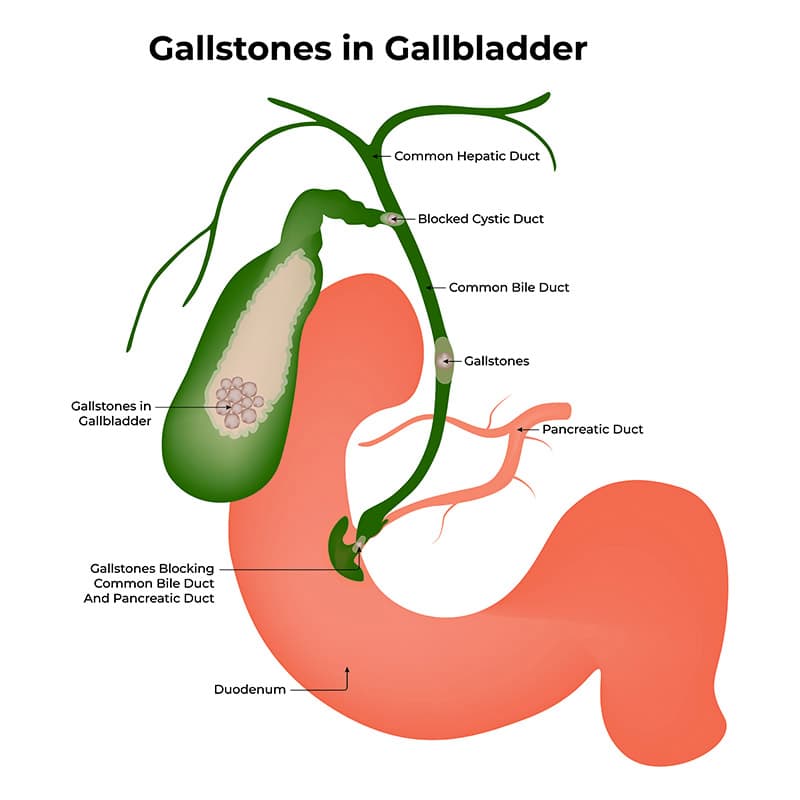 Gallstones