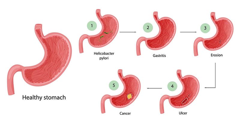 Helicobacter pylori progression chart
