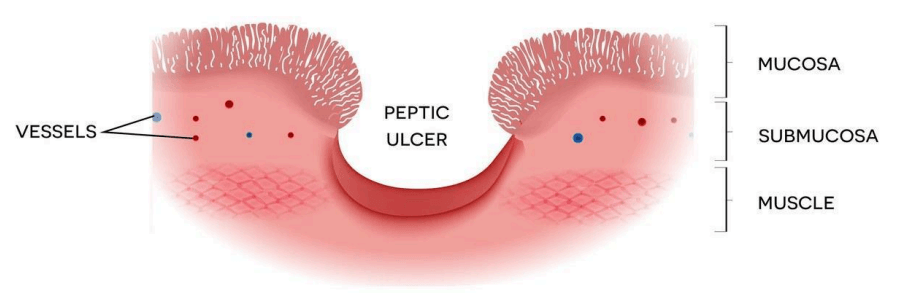 Cross section of a peptic ulcer showing an open sore eroding through the mucosa and submucosa of the stomach wall