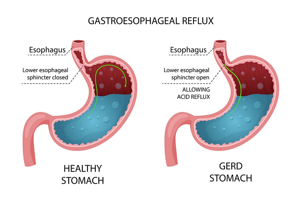 Gerd stomach diagram