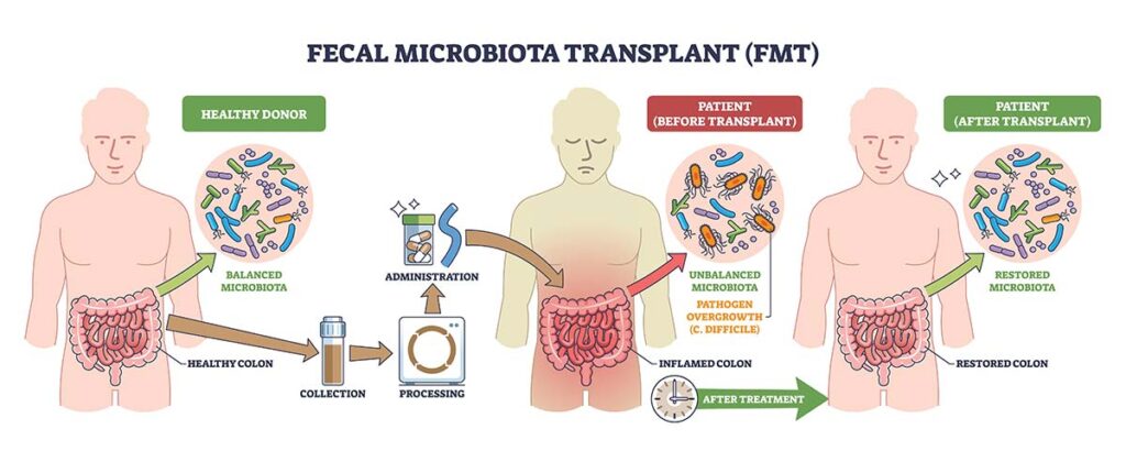 Diagram showing how FMT works, from donor to patient