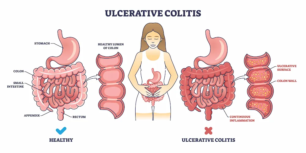 Image explaining ulcerative colitis