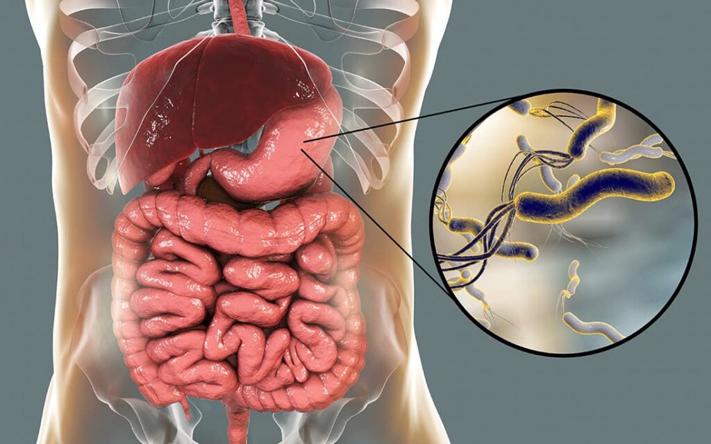 Illustration showing H. pylori bacteria colonising the stomach lining, with a detailed view of the bacteria