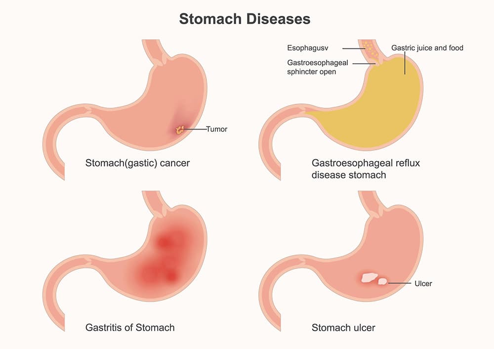 Diagram showing the stomach and duodenum, highlighting areas affected by gastritis and duodenitis