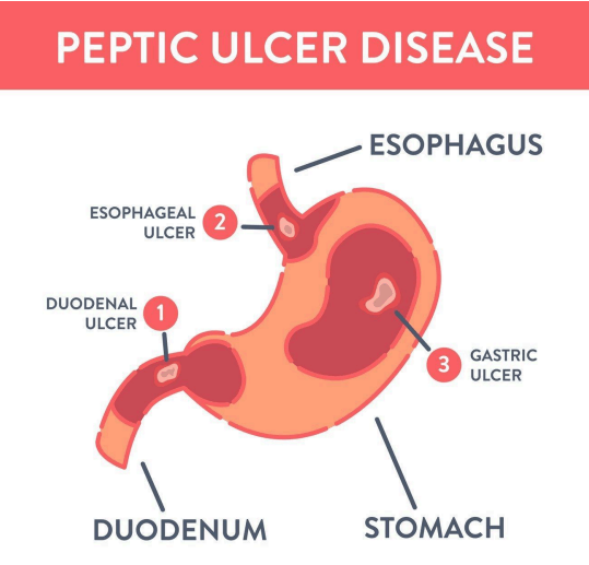 Diagram of peptic ulcer disease showing gastric, duodenal and oesophageal ulcers in the stomach and duodenum